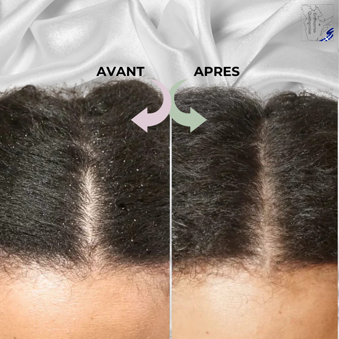 Peigne Fereine  Révélation™: Dites Adieu Aux Pellicules, Retrouvez Votre Confiance!
